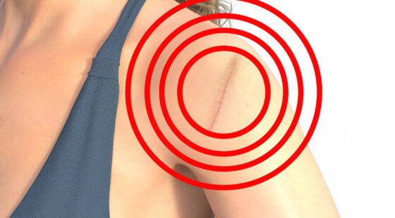 mikrostrom-microcurrent-schulter-shoulder