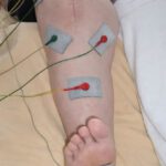 mikrostrom-knie-tep